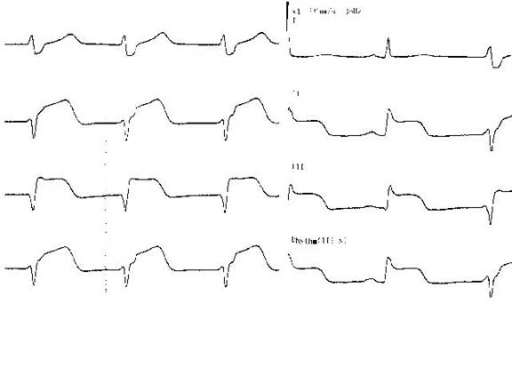 Реперфузионная аритмия при трансмуральном заднем инфаркте миокарда: эпизод узлового ритма с самостоятельным восстановлением синусового ритма