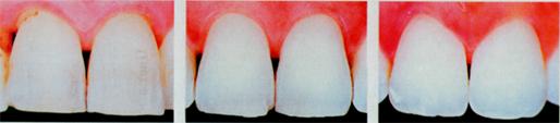 Зубы пожилого человека.  Зубы человека среднего возраста. Зубы ребенка.