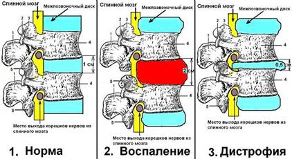 Схематическое изображение двух стадий остеохондроза