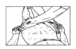 Рисунок 87 - 3. Постизометрическая релаксация большой ягодичной мышцы