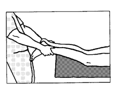 Тракция позвоночника с использованием обеих нижних конечностей в положении больного лежа на животе