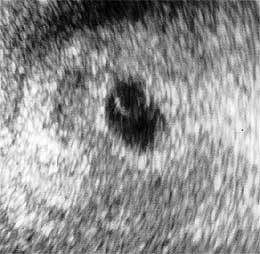 Эмбрион 3,5 недели