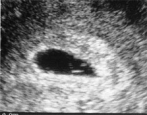 Эмбрион 4 недели