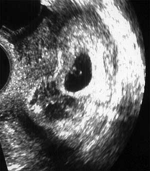 Эмбрион 5 недель