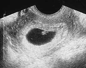 Эмбрион 6 недель