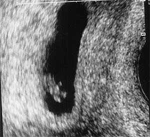Эмбрион  7 недель