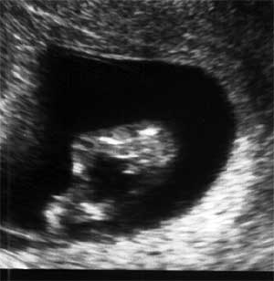 Эмбрион, девочка, 10 недель