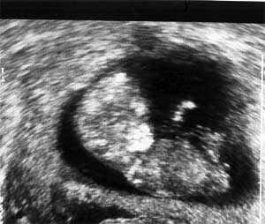 Эмбрион  11  недель