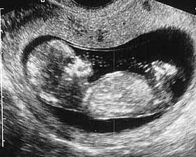 Эмбрион  12  недель