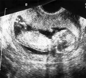 Эмбрион  12  недель