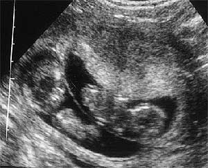 Эмбрионы  12  недель. Разнояйцевые близнецы