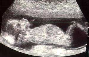 Беременность, плод 14 недель, переднее предлежание плаценты