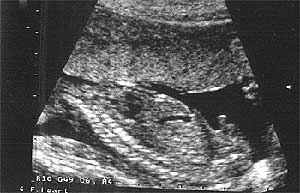 Беременность, плод 17 недель, мальчик, переднее предлежание плаценты