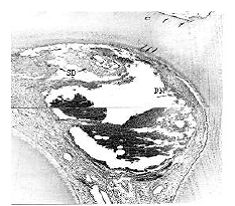 Сложная микрофотография области рога пульпы вблизи  кариозного очага
